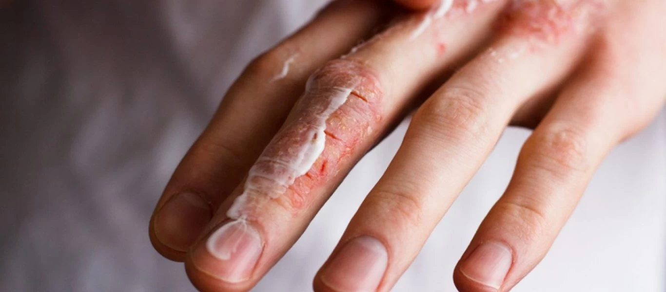 Οι τέσσερις ασθένειες που στα συμπτώματά τους περιλαμβάνεται η ξηροδερμία